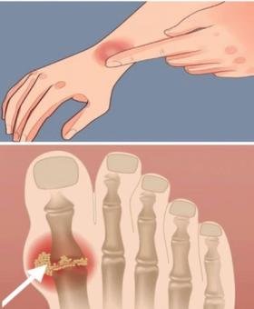 生机饮食 | 体检出尿酸高以后......