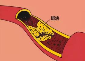  “耳朵褶皱”是冠心病迹象？！这5类人要警惕！ 