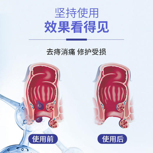 【痔疮清道夫】国药集团天目湖苗古汤医用液体敷料痔疮喷雾止痒消肿内痔外痔混合痔喷剂 商品图3
