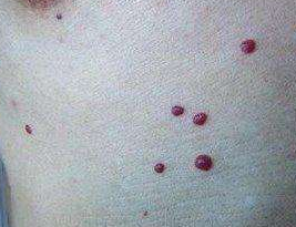 身上莫名其妙的出现血痣，那你一定要小心了！ 