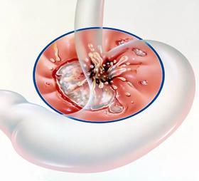 都说HPV是宫颈癌的高危因素，岂不知反复持续的妇科炎症也是宫颈癌的刽子手！