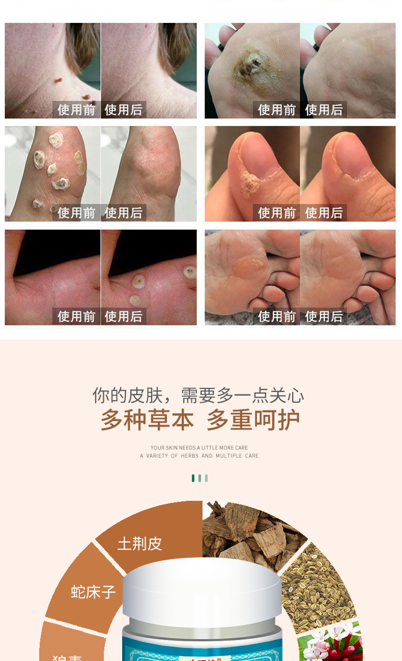 瘊优专用瘊优偏方膏自然祛疣瘊子脱落草本萃取直达根源深层渗入拒绝