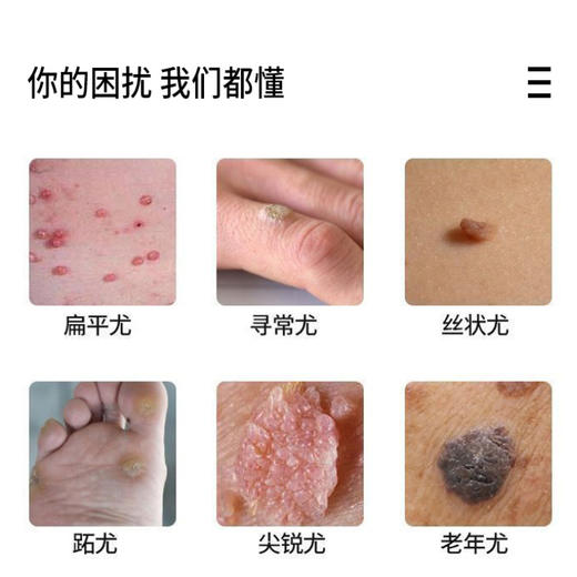 瘊优专用瘊优偏方膏自然祛疣瘊子脱落草本萃取直达根源深层渗入拒绝