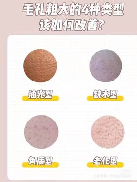 毛孔粗大的4种类型