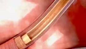  心脑血管疾病高发期，这些症状要警惕！