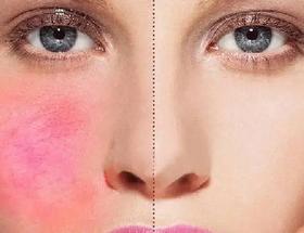  护肤科普 | 为什么在冬天一补水脸会刺痛？没想到真相是这样的...