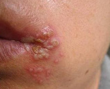  “烂嘴角”是免疫力差的象征！ 