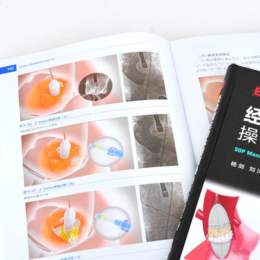 医学精萃系列 经导管主动脉瓣置换操作指南手册 国内经导管主动脉瓣置换操作规范书籍 TAVR全流程技术操作规范书籍 心血管疾病治疗 无 化学工业出版社 9787122397386 商品图3