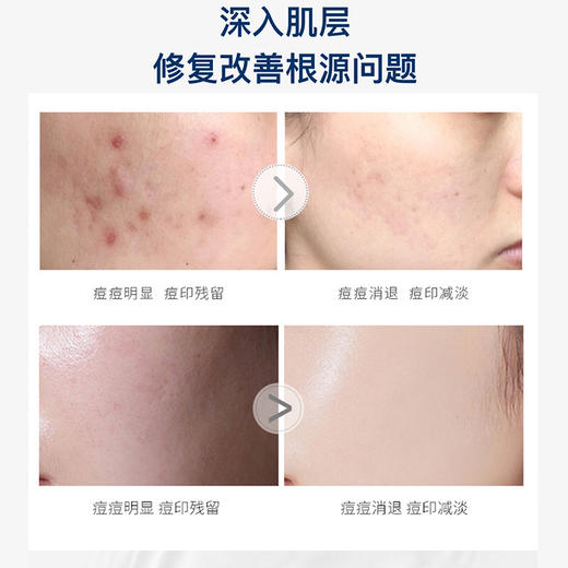 【第二支半价】 乐敦暗疮膏祛痘膏 去印膏 一套 修护青春痘清爽不油腻 商品图1