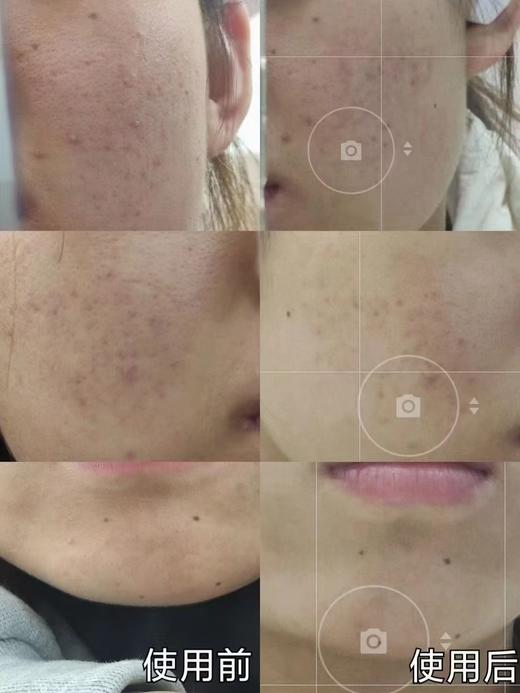 芙清新版祛痘精华30ml 商品图5