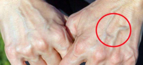 “青筋” 凸起，意味着什么?您了解过吗？ 