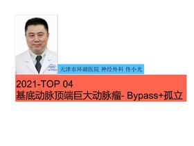 2021Top4 基底动脉顶端巨大动脉瘤ECA-RA-P2Bypass动脉瘤孤立