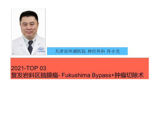 2021Top3 复发岩斜区脑膜瘤/Fukushima Bypass及脑膜瘤切除 商品图0