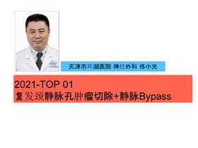 2021Top1 颈静脉孔复发肿瘤切除术/ 乙状窦-SV-颈外静脉 Bypass