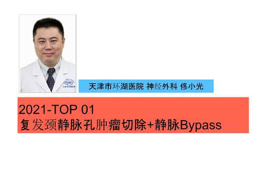 2021Top1 颈静脉孔复发肿瘤切除术/ 乙状窦-SV-颈外静脉 Bypass 商品图0