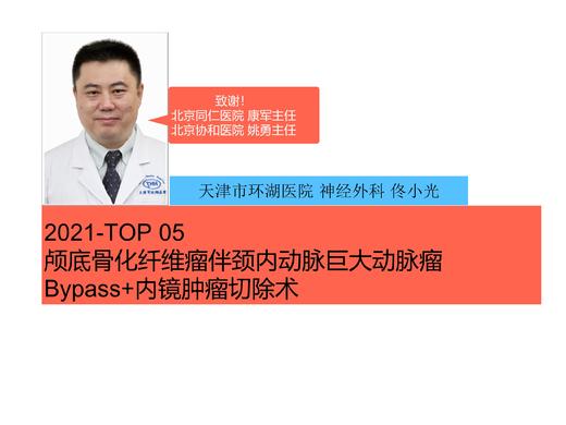 2021Top5 颅底骨质异常增生合并巨大动脉瘤- Bypass/内镜切除术 商品图0