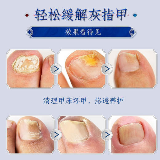 【买2送1买3送2】苗古汤手足通用液体敷料灰指甲液体敷料植物配方温和不伤甲轻轻一抹灰甲变亮甲 商品图4