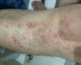 春季过敏季，皮肤瘙痒红肿、长湿疹，一灸断根 