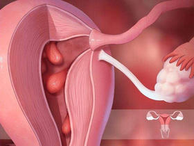 备孕小老虎迟迟不怀孕，拦路虎可能是子宫息肉！