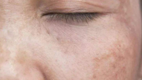 天天闹着祛斑，却忽视了最重要的3点！ 