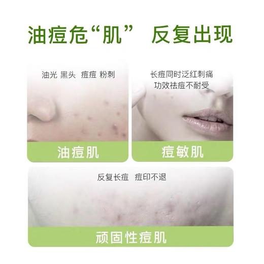 新品 绽妍祛痘凝胶30g(二械） 商品图3