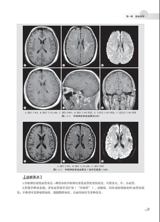 神经影像征象解析非肿瘤篇 医学影像联盟丛书 王宇军 白玉贞 徐守军 神经系统疾病影像诊断 科学技术文献出版社9787518985081 商品图3