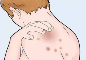 春天皮肤病反复，春风吹又犯。别急！止痒祛湿艾灸能帮你！ 