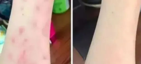  这才是老牌国货该有的样子：用它一抹止痒不复发，10年湿疹被“制服”！ 