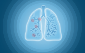  体检发现肺结节就一定是肺癌吗？只能通过大小和生长速度判别良恶性吗？ 