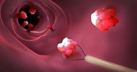  有肠息肉就一定要割了？！研究发现：九成直肠癌源于“息肉癌变”！ 