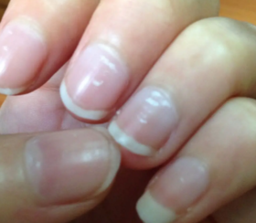 指甲月牙少、有白点、竖纹，是不是身体出问题了？5个小变化千万别忽视 