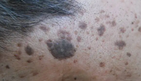 黑斑是瘀血积滞，白斑是毒素积滞，红斑是...... 