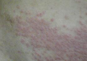 湿疹难缠，受罪又毁皮肤！巧用一招，连根“拔掉”湿疹！ 