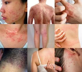 湿疹皮炎、皮肤瘙痒有救了！抹一抹3秒止痒，7天去疹，根源解决99%皮肤顽疾！ 