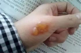 艾灸后出现的灸痕、水泡，可判断出你体内湿气的严重性！ 