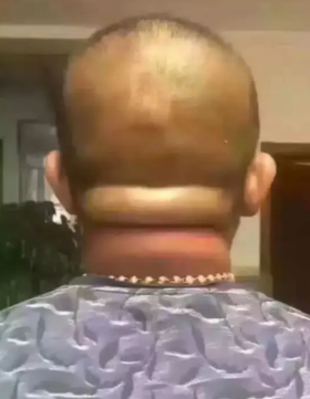 脑后堆肉是脑梗的前兆，一定要重视！艾灸可消除脑后堆肉 