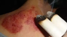 灸友反馈：我用艾灸治疗的经验之谈！！ 