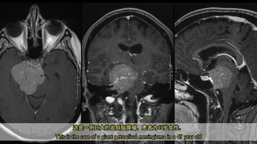 2021/Top3.巨大岩斜脑膜瘤手术（中英双语字幕） 商品图0