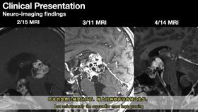 2021/Top4.内镜下 下丘脑畸胎瘤手术切除（双语字幕）
