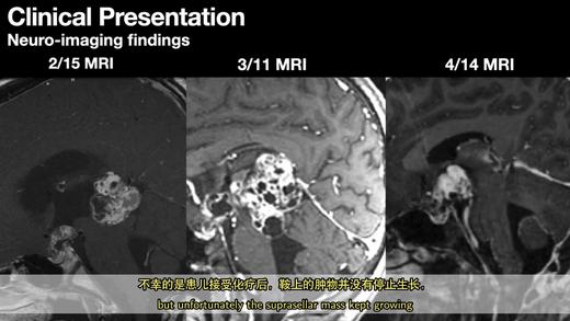 2021/Top4.内镜下 下丘脑畸胎瘤手术切除（双语字幕） 商品图0