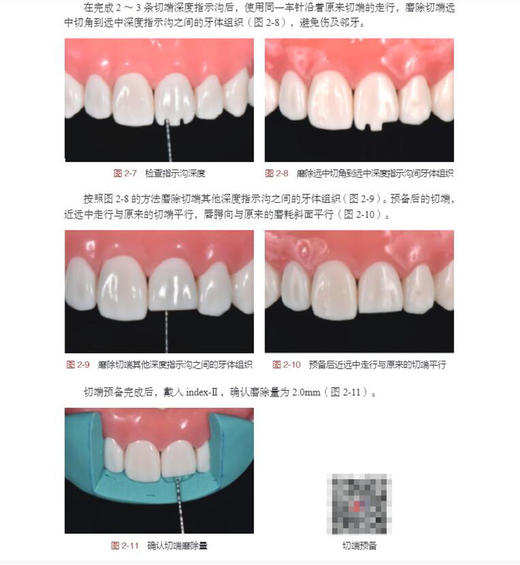 牙体缺损修复备牙过程图解 牙全瓷冠牙体预备 开窗型前牙瓷贴面牙体预备 口腔书 蓝菁 林东 葛少华 9787030673015 科学出版社 商品图4