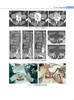 经椎间孔腰椎微创融合术 毛克亚 王征 腰椎脊柱病 显微外科学 临床应用MIS-TLIF的实践和体会 9787565920356北京大学医学出版社 商品缩略图4