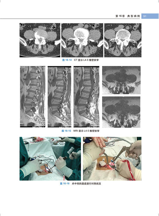 经椎间孔腰椎微创融合术 毛克亚 王征 腰椎脊柱病 显微外科学 临床应用MIS-TLIF的实践和体会 9787565920356北京大学医学出版社 商品图4