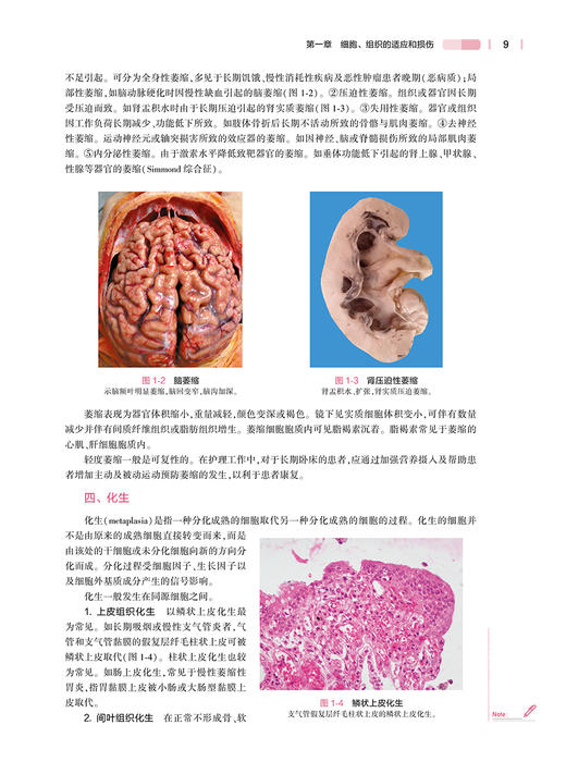 病理学与病理生理学 第五5版 十四五规划教材全国高等学校教材 供本科护理学类专业用 步宏 王雯人民卫生出版社9787117327404 商品图4