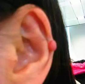  长小疙瘩、皮肤发痒都暗示肿瘤来临,赶紧看看! 