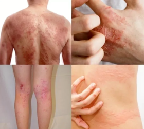 夏季过敏季，皮肤瘙痒红肿、长湿疹，一抹断根！同事惊叹犹如换皮！ 