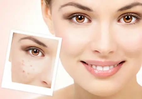 41 | 你想不到的痘印痘坑消灭大法 商品图0