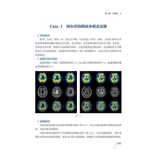 PET/CT，PET/MR与SPECT疑难病例集萃(精)/临床病例精析丛书/赵葵/潘建虎/张联合/王祖飞/浙江大学出版社 商品图5