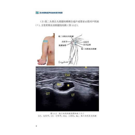 肌肉骨骼超声检查病理学精要(精)/运动系统常见疾病肌骨超声诊断学系列/陈作兵/王亭贵/陈文翔/浙江大学出版社 商品图3