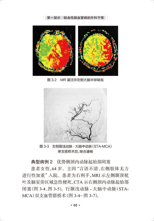 脑卒中外科治疗 第2版 康德智 张鸿祺 缺血性出血性脑血管病的外科干预和复合性手术技术 人民卫生出版社9787117328401 商品图4